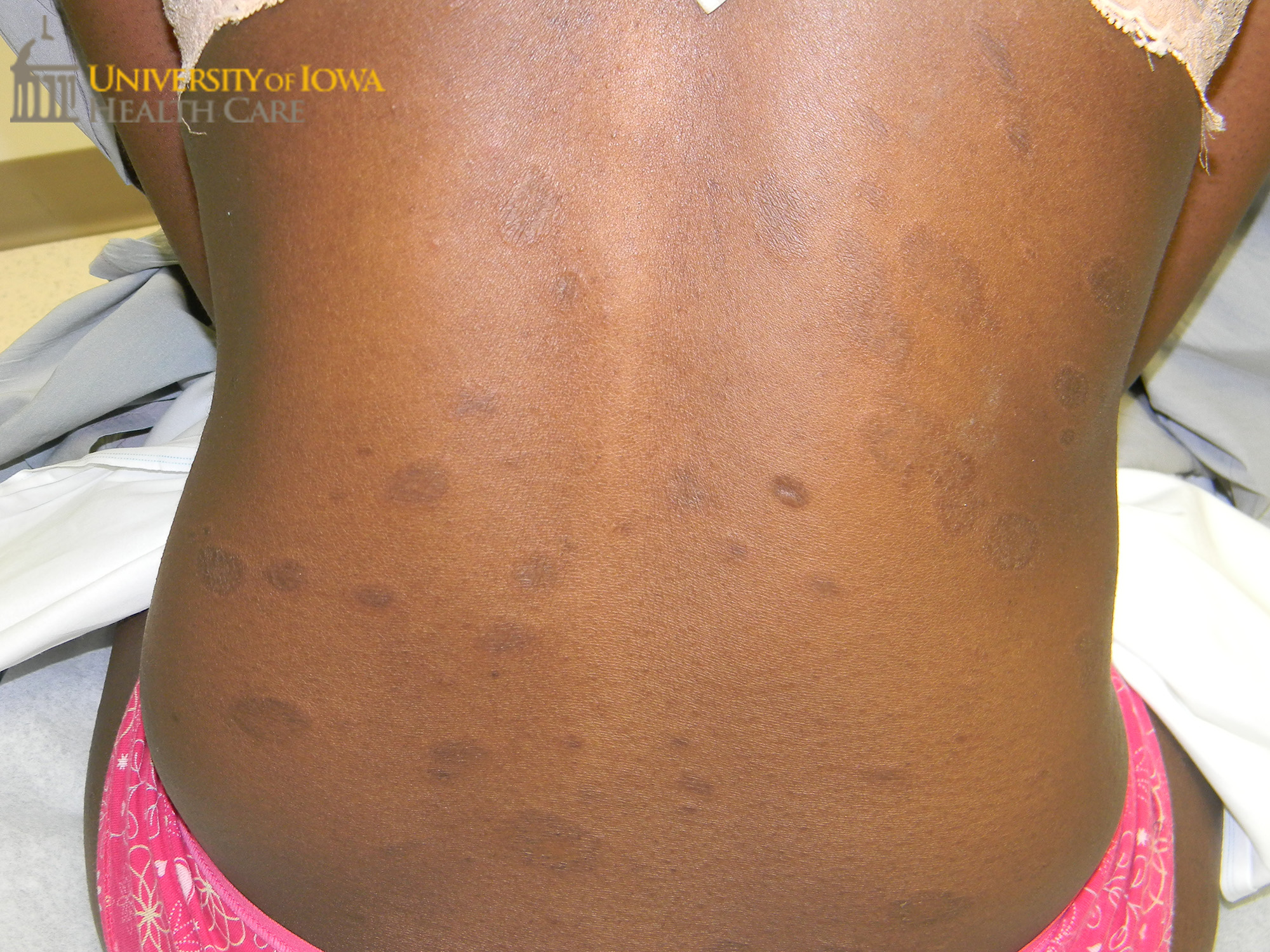 Ovoid gray-brown papules and plaques with fine scale. (click images for higher resolution).